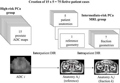 Adaptive dose painting for prostate cancer